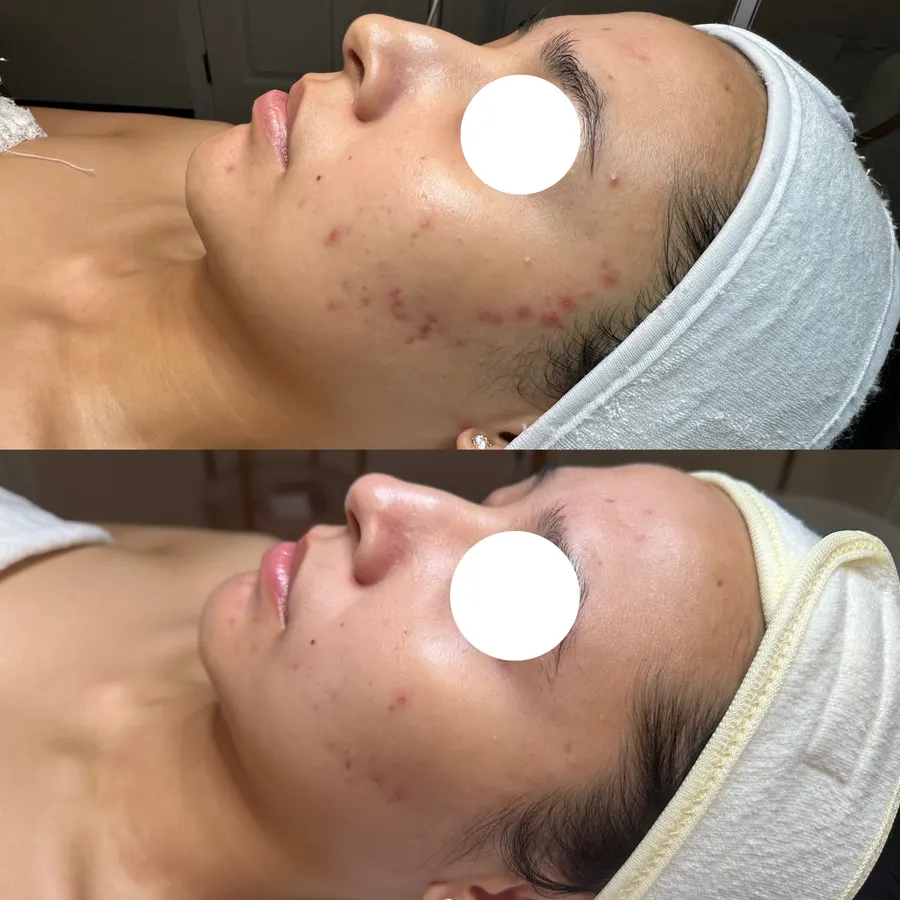 Calmer skin, softened marks, real before and after at SORA Skin & Ritual House in Peoria, AZ