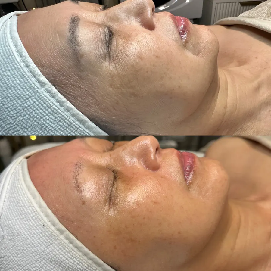 Refined texture, healthier tone, real before and after at SORA Skin & Ritual House in Peoria, AZ