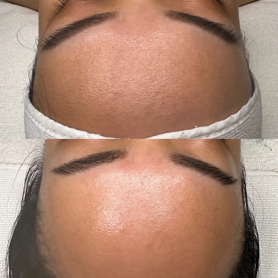Smoother, clearer forehead, real before and after at SORA Skin & Ritual House in Peoria, AZ