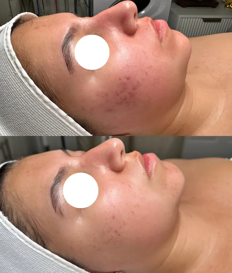 Less redness, clearer cheek, real before and after at SORA Skin & Ritual House in Peoria, AZ
