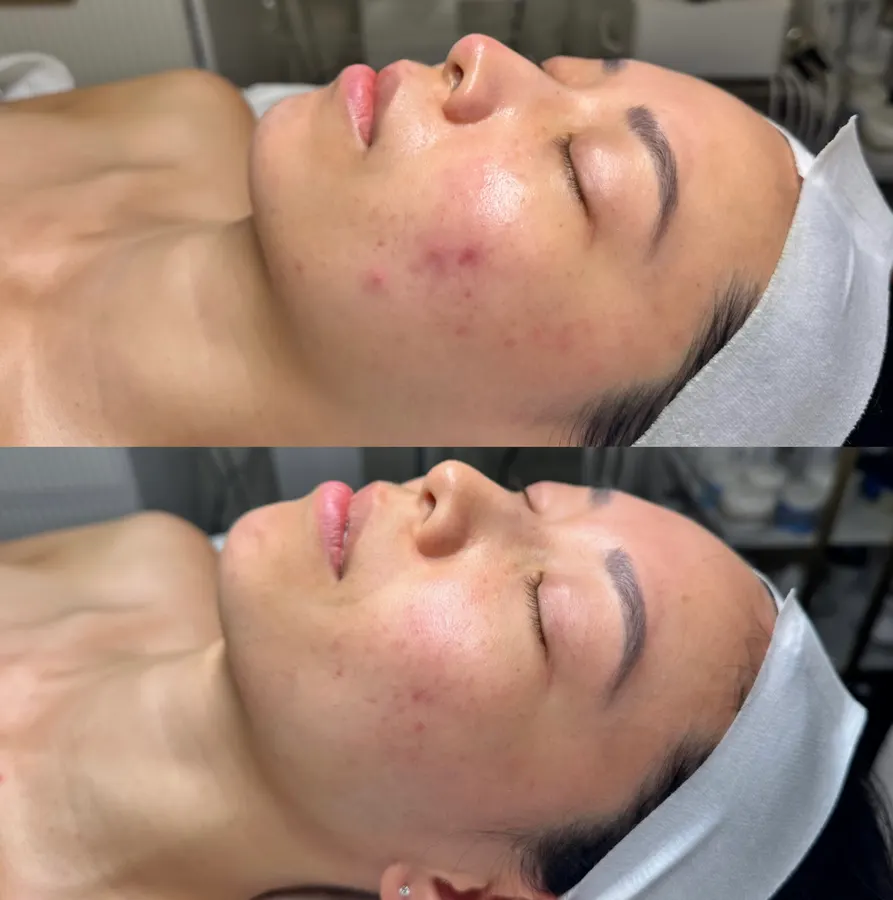 Clearer skin, even tone, real before and after at SORA Skin & Ritual House in Peoria, AZ