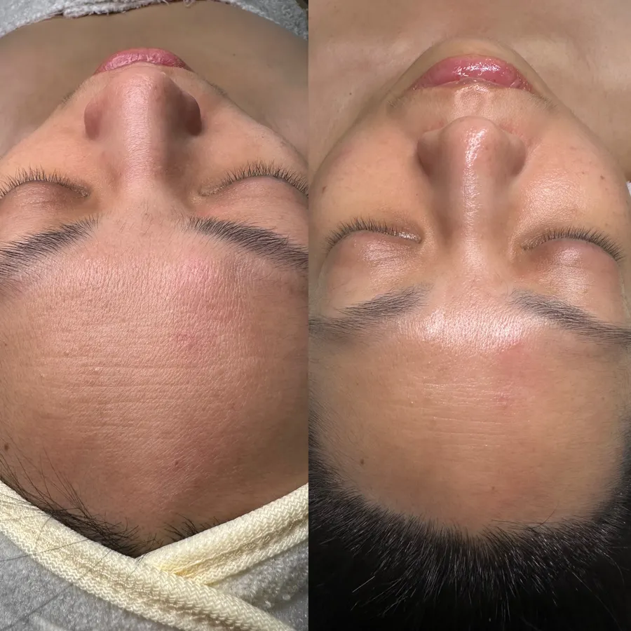 Tighter pores, smoother forehead, real before and after at SORA Skin & Ritual House in Peoria, AZ