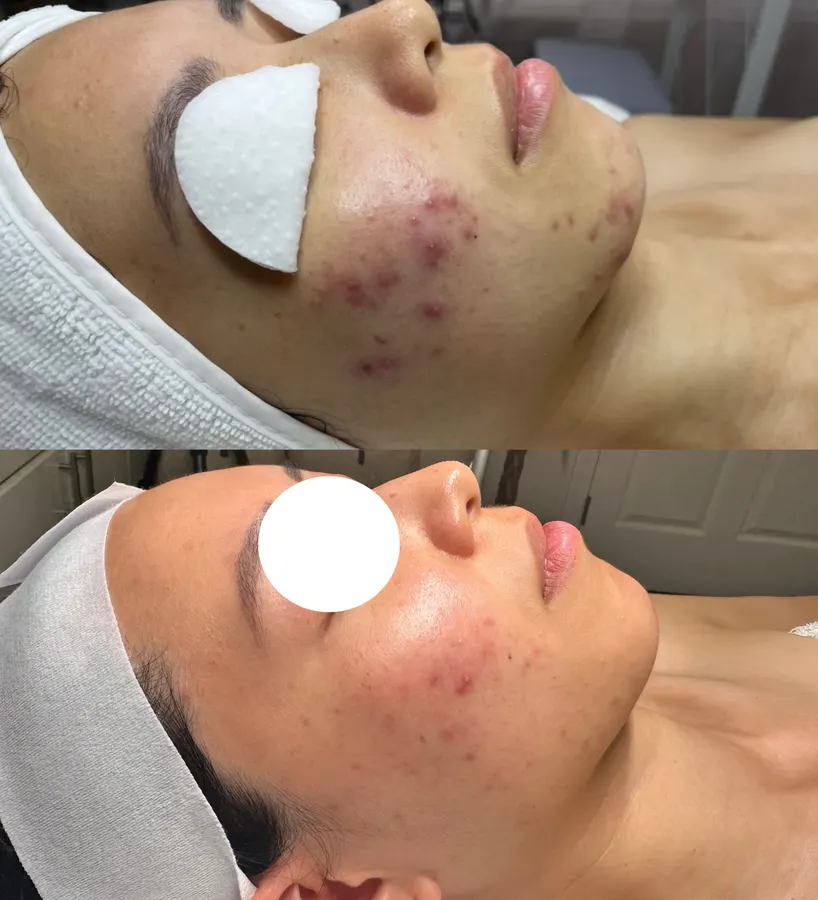 Breakout recovery, calmer skin, real before and after at SORA Skin & Ritual House in Peoria, AZ