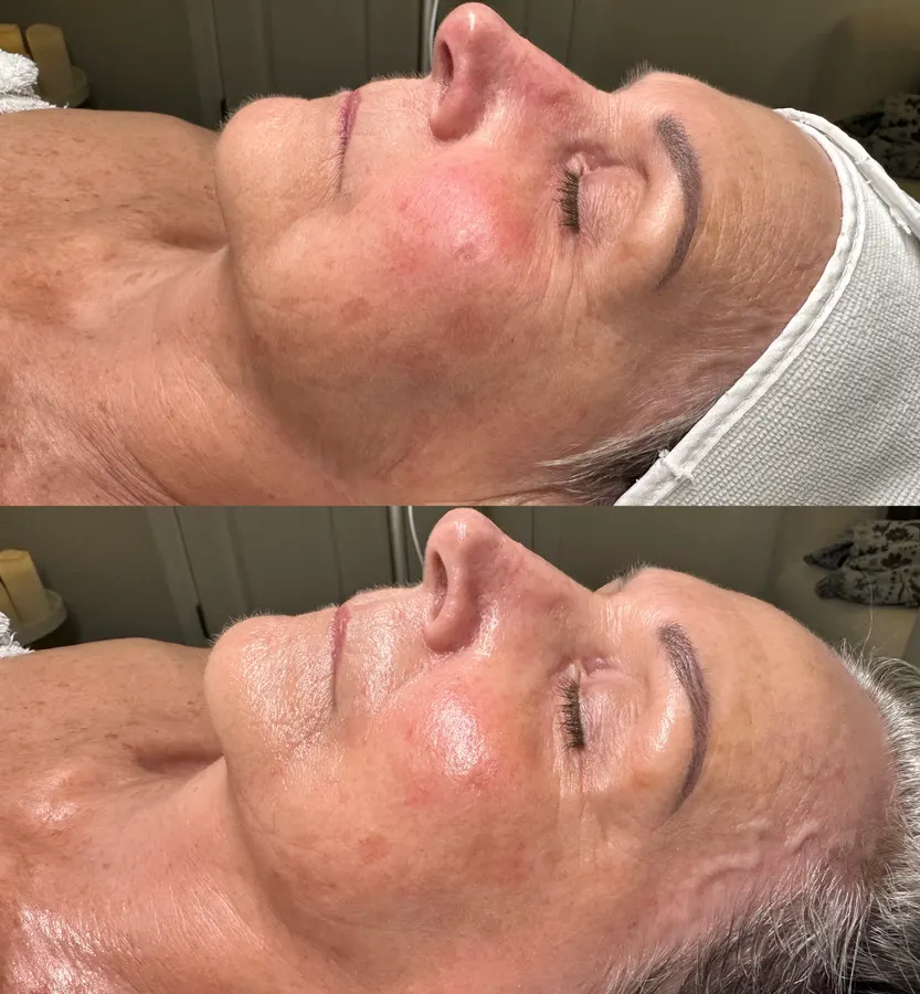 Refreshed, radiant complexion, real before and after at SORA Skin & Ritual House in Peoria, AZ