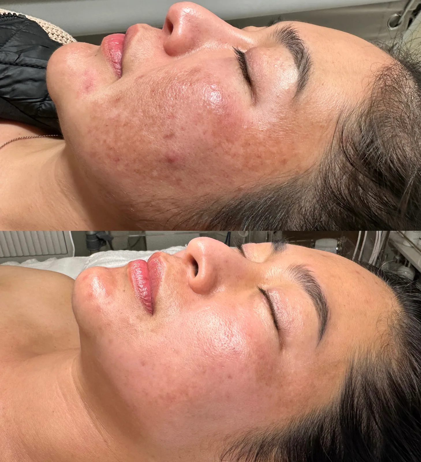 Corrective Pigment Protocols case study, before and after at SORA Skin & Ritual House