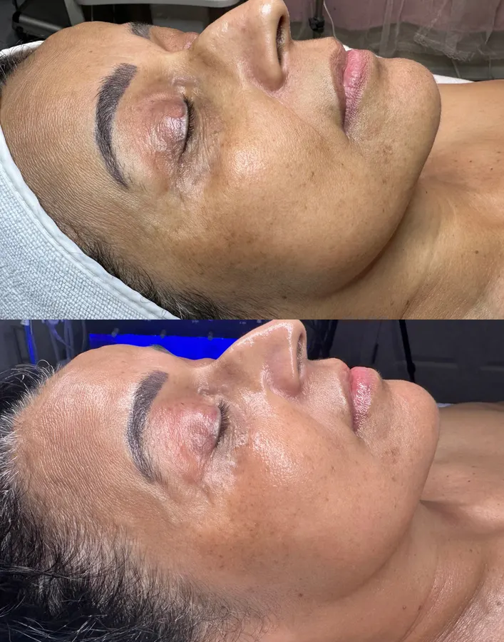 Faded pigment, even tone, real before and after at SORA Skin & Ritual House in Peoria, AZ